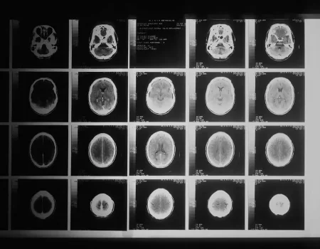 Adaptif Radyoterapi İle Kişiye Özel Dinamik Kanser Tedavisi