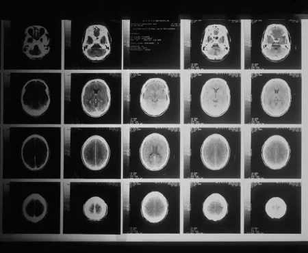 Adaptif Radyoterapi İle Kişiye Özel Dinamik Kanser Tedavisi